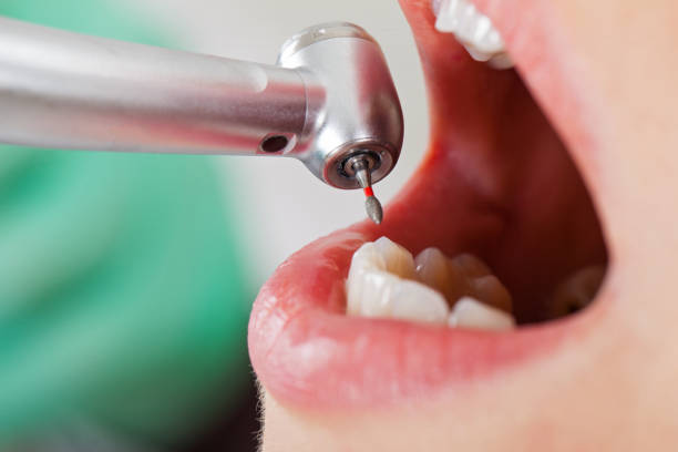 Best Emergency Dentist for Knocked-Out Tooth in South Barre, VT